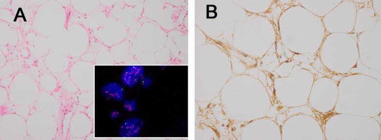 The histologic features of ALT-WDLs and corresponding FRS2 FISH and FRS2 immunostaining results.jpg